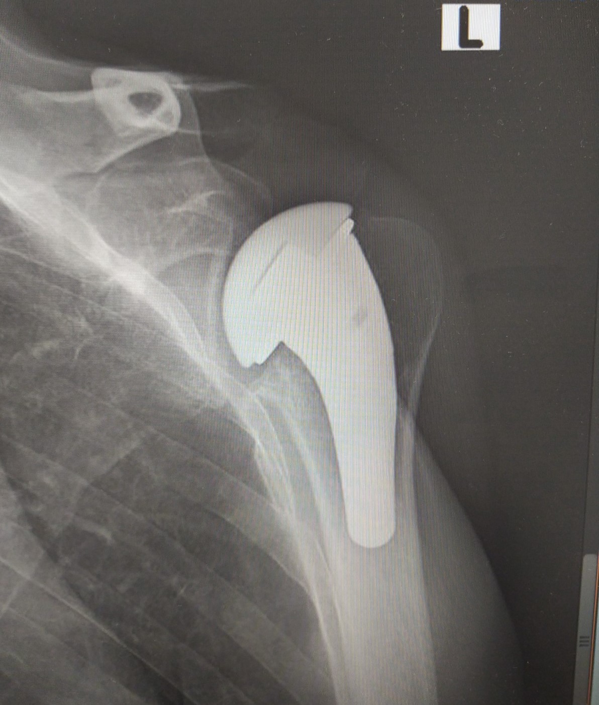HEMIARTHROPLASTY
